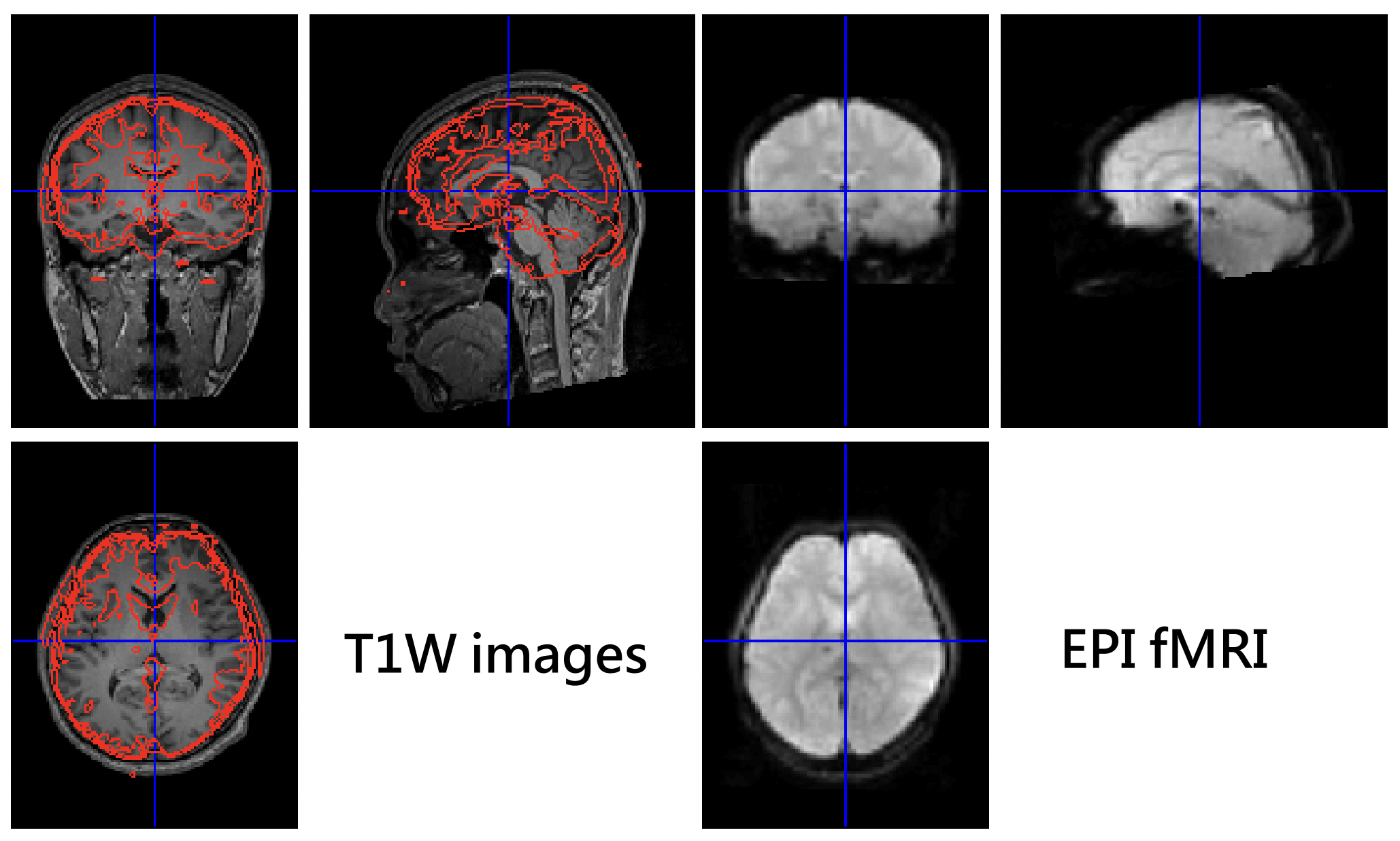 合併 T1W 與 EPI 到同一個座標上。