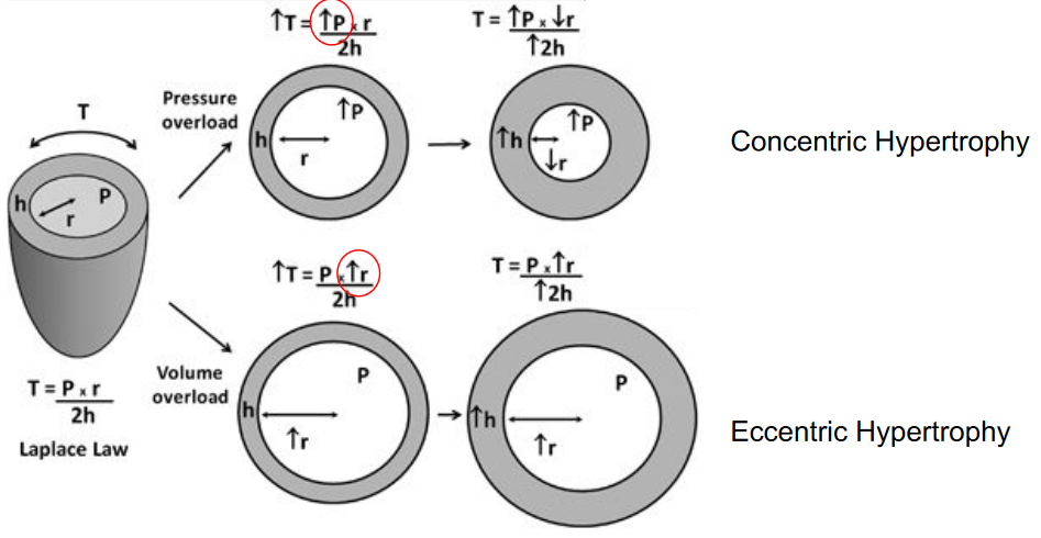 LaPlace's Wall Stress Formula