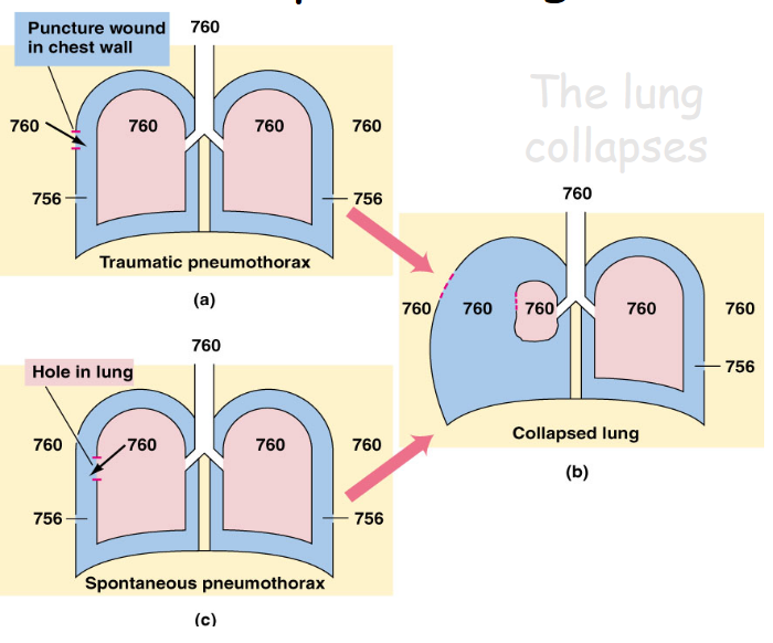 Pneumothorax Mechanism