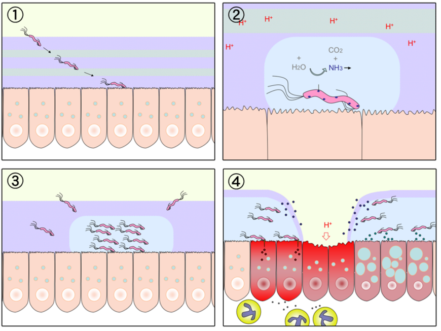 H. pylori Causing Ulcers