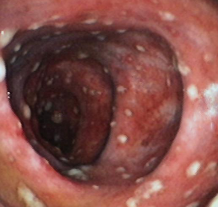 Pseudomembranous Colitis