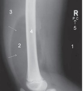 X-Ray of a Child's Thigh Containing Benign Lipomas (i.e., the arrows)