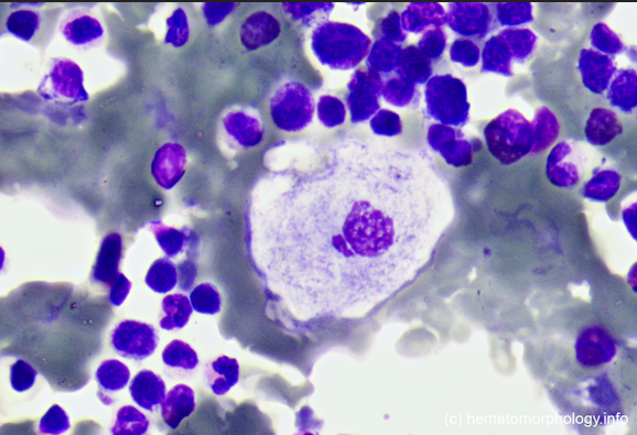 Cell Stain of a Patient with Gaucher's Disease